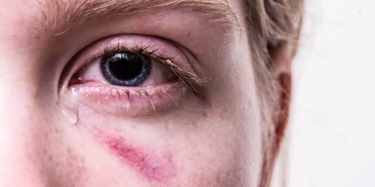 Πάνω από μία στις τέσσερις γυναίκες έχει υποστεί βία από τον σύντροφό της παγκοσμίως – Στην Ελλάδα το 18%