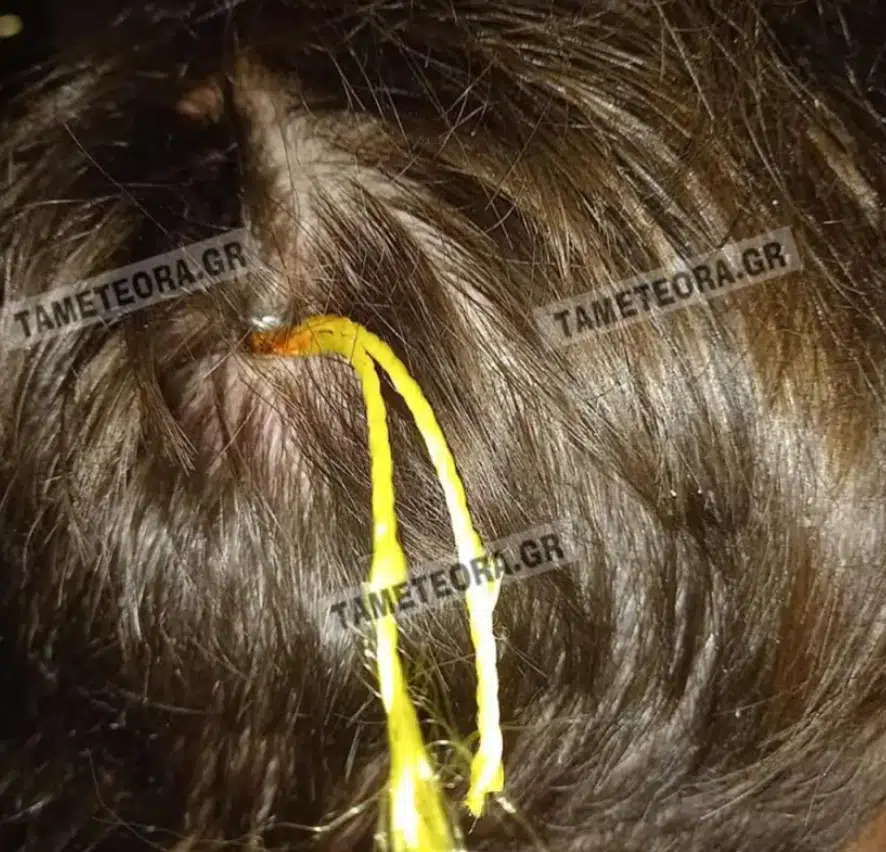 καρφι1 - Καρφί 5 εκατοστών σφηνώθηκε στο κεφάλι άνδρα στην Καλαμπάκα (εικόνες)