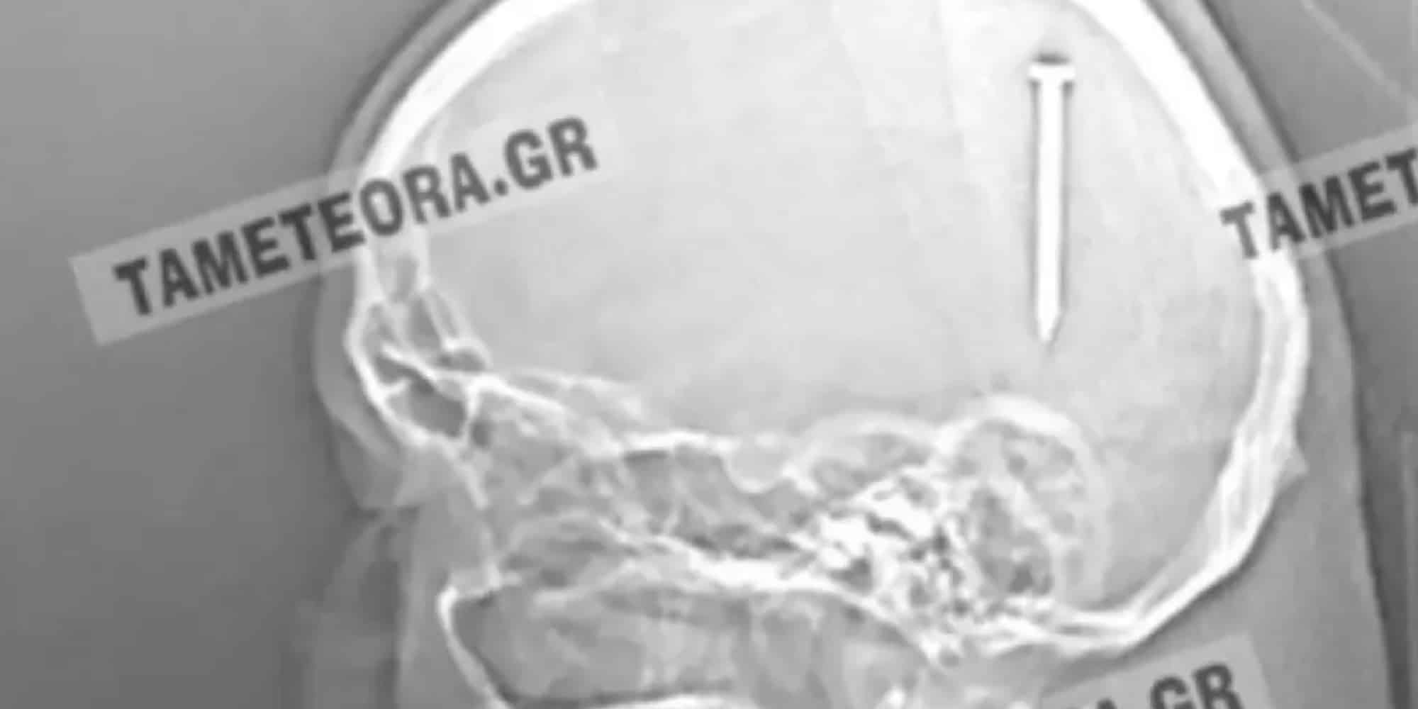Καρφί 5 εκατοστών σφηνώθηκε στο κεφάλι άνδρα στην Καλαμπάκα (εικόνες)