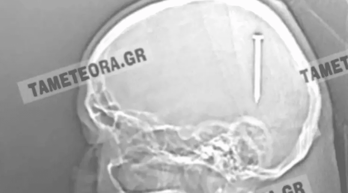 Καρφί 5 εκατοστών σφηνώθηκε στο κεφάλι άνδρα στην Καλαμπάκα (εικόνες)