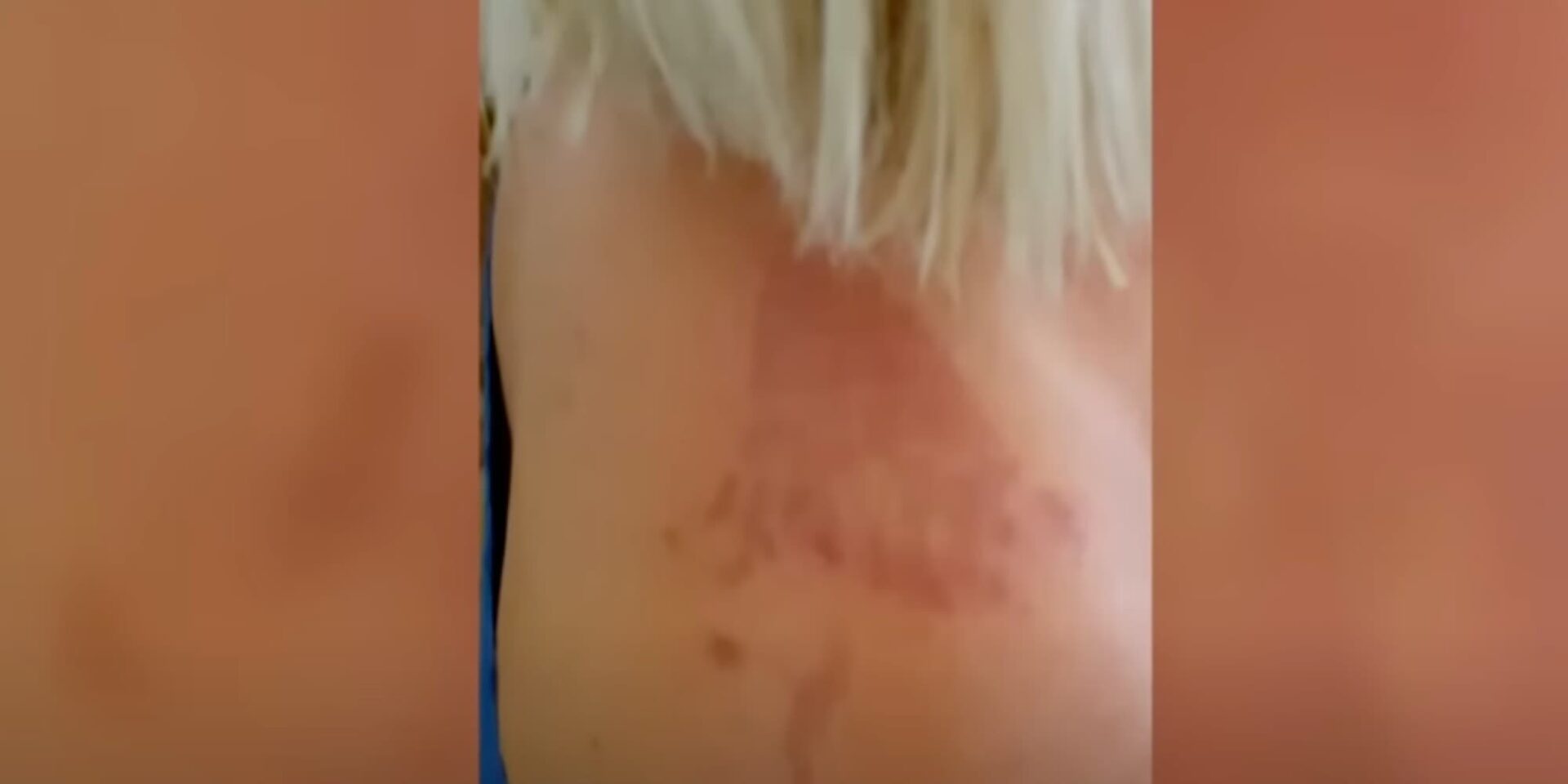 Μωβ μέδουσα τσίμπησε γυναίκα στα Μέγαρα