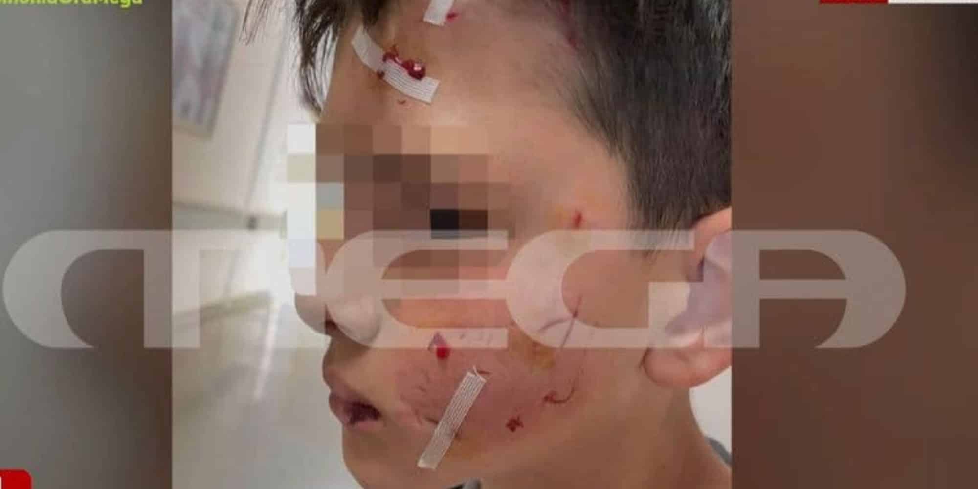 Εικόνα από το πρόσωπο του 13χρονου μετά την επίθεση του σκύλου