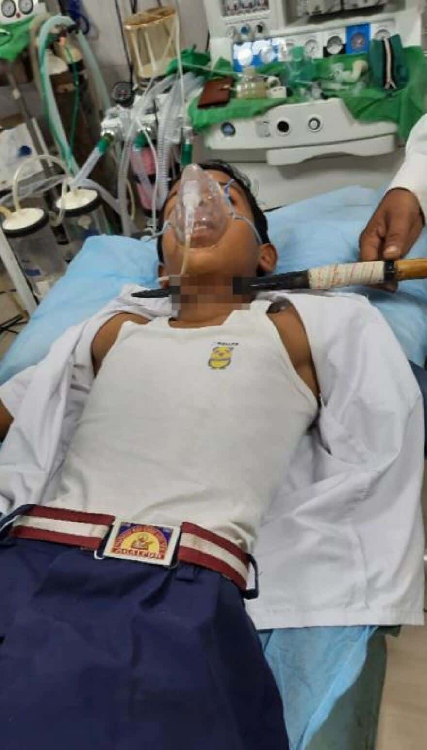 akontio 2 - Αδιανόητο περιστατικό στην Ινδία: Ακόντιο καρφώθηκε στον λαιμό 14χρονου - Συγκλονιστικές εικόνες και βίντεο