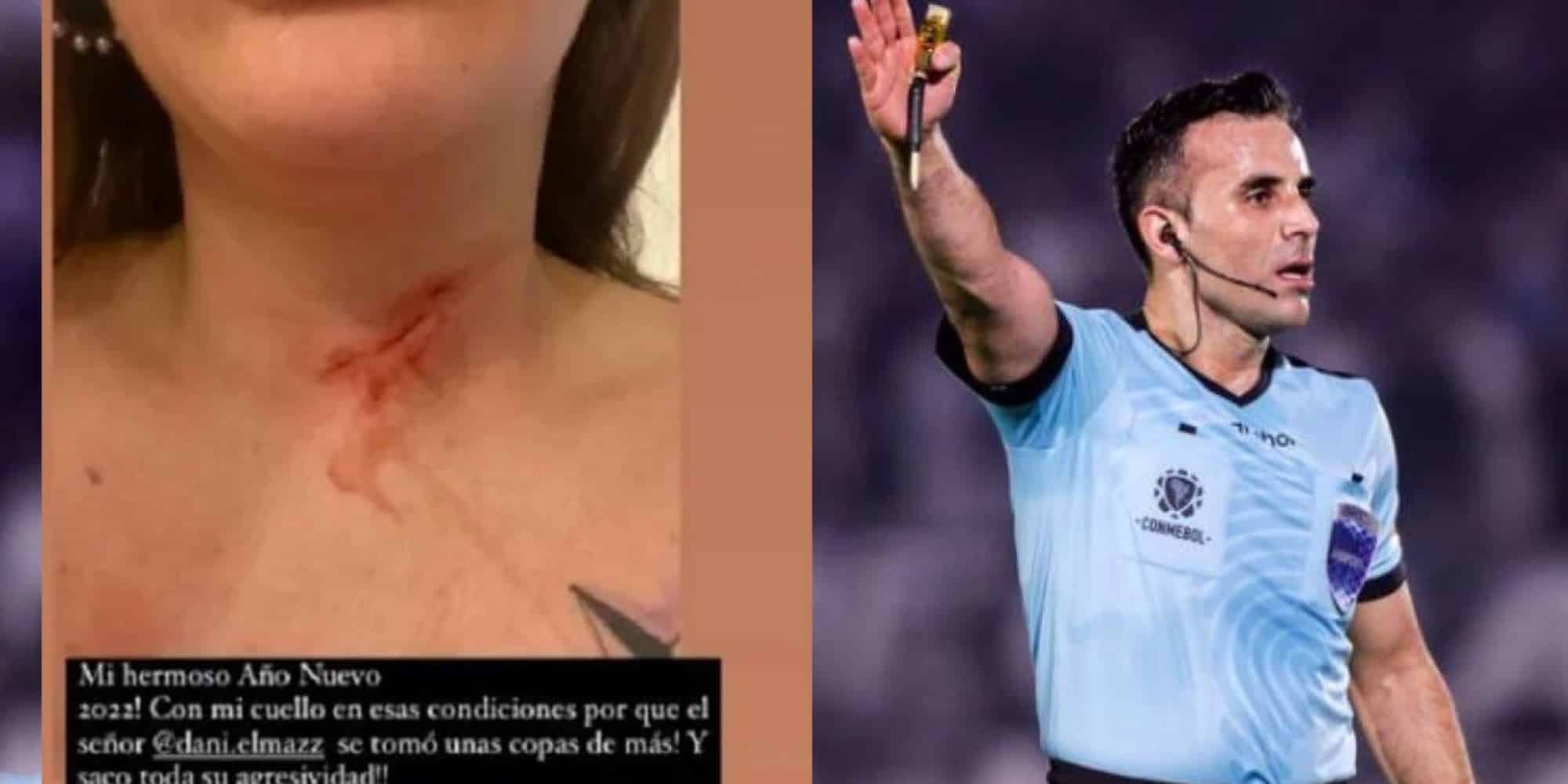 Εικόνα από την τραυματισμένη γυναίκα και ο διαιτητής από την Χιλή που κατηγορείται για ξυλοδαρμό