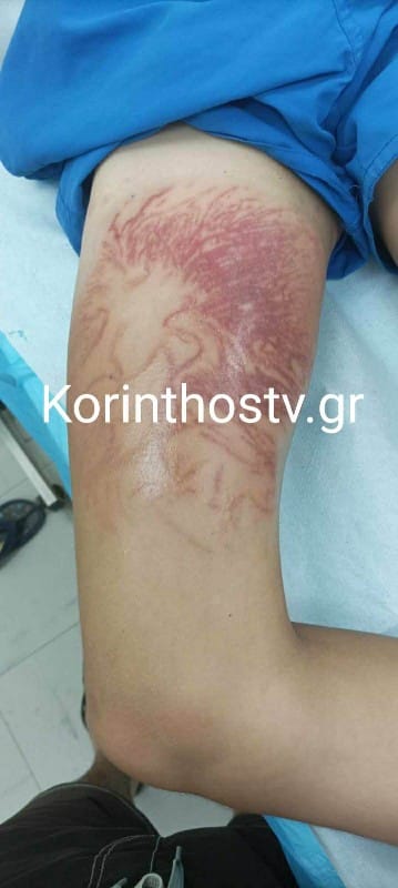 Στο νοσοκομείο 9χρονος που δέχτηκε τσίμπημα από θαλάσσια ανεμώνη στο Καλαμάκι Κορινθίας
