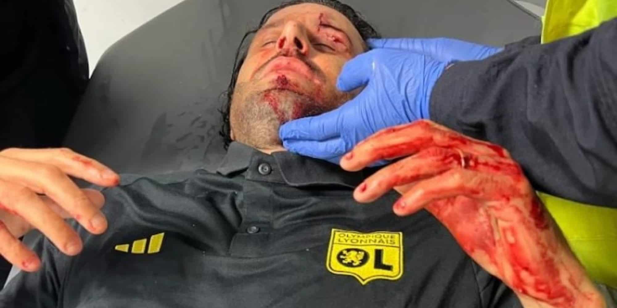 Τραυματίστηκε ο Φάμπιο Γκρόσο μετά από επίθεση στο πούλμαν της Λιόν