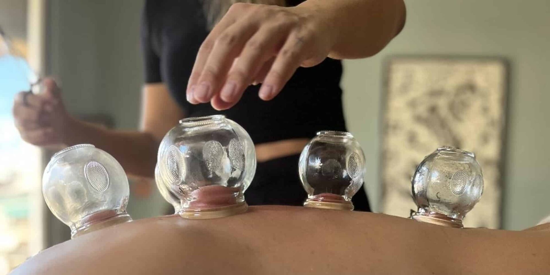 Cupping therapy