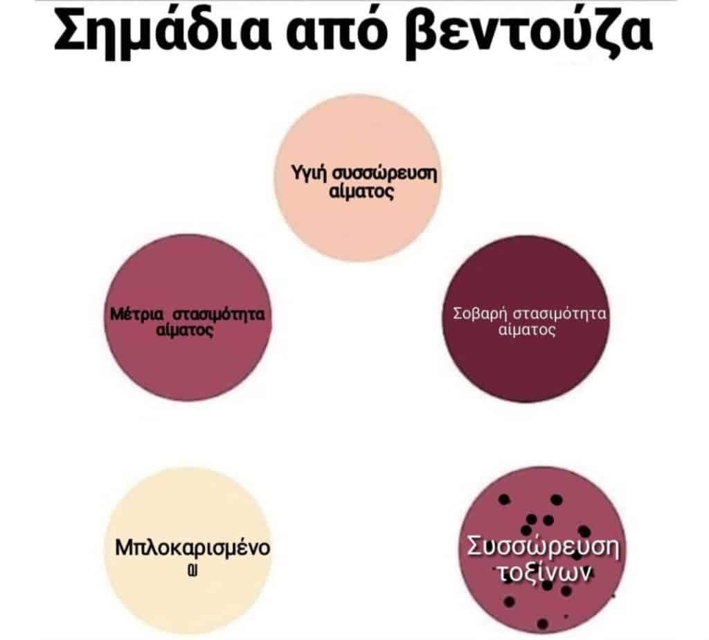 Το cupping therapy δεν έχει καμιά σχέση με όσα γνωρίζεις - Οι βεντούζες, οι μέθοδοι εφαρμογής και τα σημάδια (εικόνες)